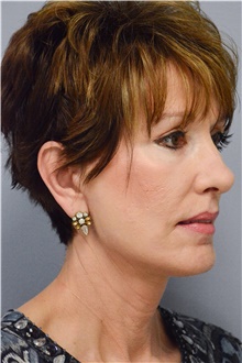 Facelift After Photo by Carlos Rivera-Serrano, MD; Miami Beach, FL - Case 43697