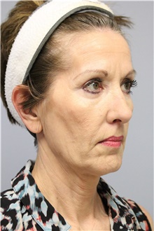 Facelift Before Photo by Carlos Rivera-Serrano, MD; Miami Beach, FL - Case 43697