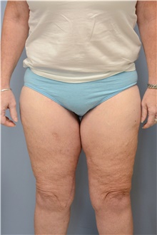 Thigh Lift After Photo by Carlos Rivera-Serrano, MD; Miami Beach, FL - Case 43747