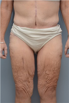 Thigh Lift Before Photo by Carlos Rivera-Serrano, MD; Miami Beach, FL - Case 43747