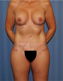 Body Lift After Photo by Siamak Agha, MD PhD FACS; Newport Beach, CA - Case 43862