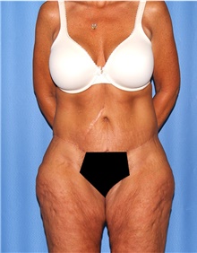 Body Lift Before Photo by Siamak Agha, MD PhD FACS; Newport Beach, CA - Case 43862