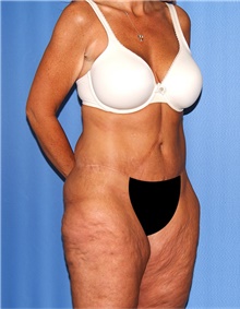 Body Lift Before Photo by Siamak Agha, MD PhD FACS; Newport Beach, CA - Case 43862