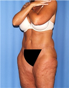 Body Lift Before Photo by Siamak Agha, MD PhD FACS; Newport Beach, CA - Case 43862