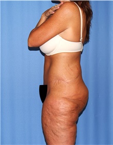 Body Lift Before Photo by Siamak Agha, MD PhD FACS; Newport Beach, CA - Case 43862