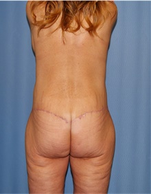 Body Lift After Photo by Siamak Agha, MD PhD FACS; Newport Beach, CA - Case 43862