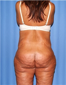 Body Lift Before Photo by Siamak Agha, MD PhD FACS; Newport Beach, CA - Case 43862