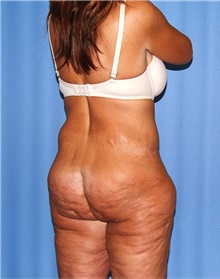 Body Lift Before Photo by Siamak Agha, MD PhD FACS; Newport Beach, CA - Case 43862