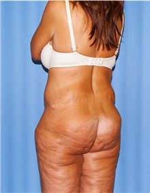 Body Lift Before Photo by Siamak Agha, MD PhD FACS; Newport Beach, CA - Case 43862