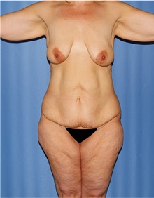Body Lift Before Photo by Siamak Agha, MD PhD FACS; Newport Beach, CA - Case 43863