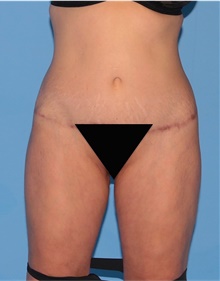 Body Lift After Photo by Siamak Agha, MD PhD FACS; Newport Beach, CA - Case 43871