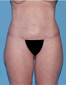 Body Lift After Photo by Siamak Agha, MD PhD FACS; Newport Beach, CA - Case 43873