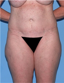 Body Lift Before Photo by Siamak Agha, MD PhD FACS; Newport Beach, CA - Case 43873