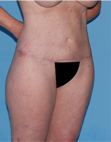 Body Lift After Photo by Siamak Agha, MD PhD FACS; Newport Beach, CA - Case 43873