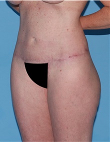 Body Lift After Photo by Siamak Agha, MD PhD FACS; Newport Beach, CA - Case 43873