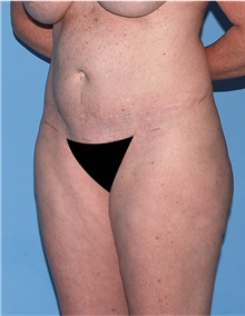Body Lift Before Photo by Siamak Agha, MD PhD FACS; Newport Beach, CA - Case 43873