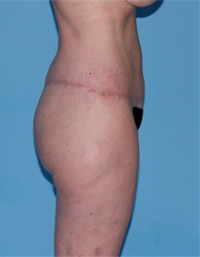 Body Lift After Photo by Siamak Agha, MD PhD FACS; Newport Beach, CA - Case 43873