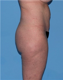 Body Lift Before Photo by Siamak Agha, MD PhD FACS; Newport Beach, CA - Case 43873