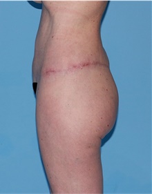 Body Lift After Photo by Siamak Agha, MD PhD FACS; Newport Beach, CA - Case 43873