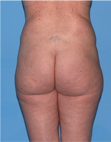 Body Lift Before Photo by Siamak Agha, MD PhD FACS; Newport Beach, CA - Case 43873