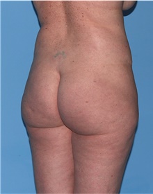 Body Lift Before Photo by Siamak Agha, MD PhD FACS; Newport Beach, CA - Case 43873