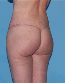 Body Lift After Photo by Siamak Agha, MD PhD FACS; Newport Beach, CA - Case 43873