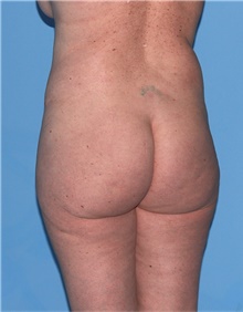 Body Lift Before Photo by Siamak Agha, MD PhD FACS; Newport Beach, CA - Case 43873