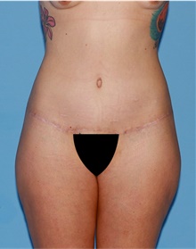 Body Lift After Photo by Siamak Agha, MD PhD FACS; Newport Beach, CA - Case 43874