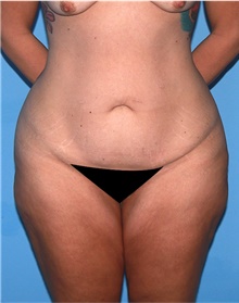 Body Lift Before Photo by Siamak Agha, MD PhD FACS; Newport Beach, CA - Case 43874
