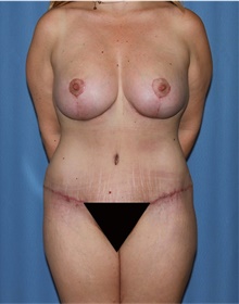 Mommy Makeover After Photo by Siamak Agha, MD PhD FACS; Newport Beach, CA - Case 43905