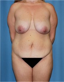 Mommy Makeover Before Photo by Siamak Agha, MD PhD FACS; Newport Beach, CA - Case 43905