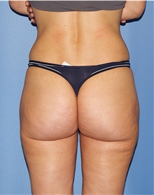 Buttock Lift with Augmentation After Photo by Siamak Agha, MD PhD FACS; Newport Beach, CA - Case 43914