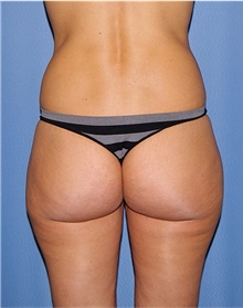 Buttock Lift with Augmentation Before Photo by Siamak Agha, MD PhD FACS; Newport Beach, CA - Case 43914