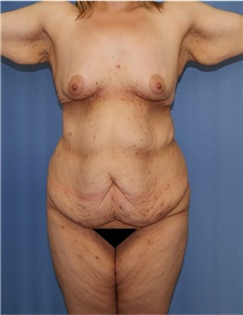 Body Lift Before Photo by Siamak Agha, MD PhD FACS; Newport Beach, CA - Case 43931