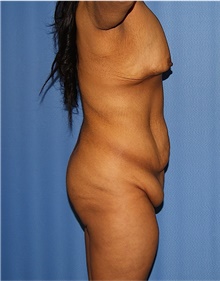 Body Lift Before Photo by Siamak Agha, MD PhD FACS; Newport Beach, CA - Case 43933
