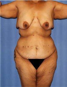 Body Lift Before Photo by Siamak Agha, MD PhD FACS; Newport Beach, CA - Case 43938