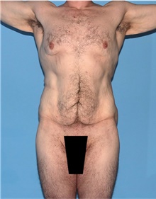 Body Lift Before Photo by Siamak Agha, MD PhD FACS; Newport Beach, CA - Case 43940