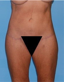 Body Lift After Photo by Siamak Agha, MD PhD FACS; Newport Beach, CA - Case 43949