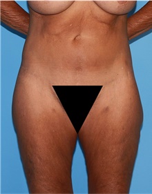 Body Lift Before Photo by Siamak Agha, MD PhD FACS; Newport Beach, CA - Case 43949