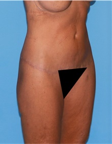 Body Lift After Photo by Siamak Agha, MD PhD FACS; Newport Beach, CA - Case 43949