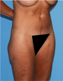 Body Lift Before Photo by Siamak Agha, MD PhD FACS; Newport Beach, CA - Case 43949