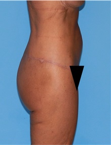 Body Lift After Photo by Siamak Agha, MD PhD FACS; Newport Beach, CA - Case 43949