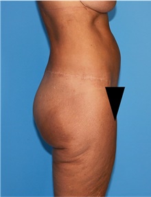 Body Lift Before Photo by Siamak Agha, MD PhD FACS; Newport Beach, CA - Case 43949