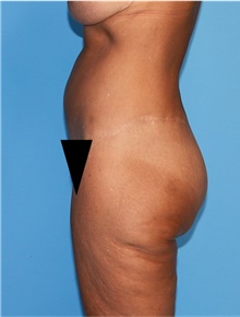 Body Lift Before Photo by Siamak Agha, MD PhD FACS; Newport Beach, CA - Case 43949