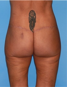 Body Lift After Photo by Siamak Agha, MD PhD FACS; Newport Beach, CA - Case 43949