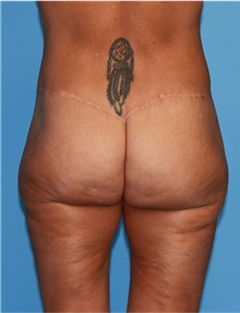 Body Lift Before Photo by Siamak Agha, MD PhD FACS; Newport Beach, CA - Case 43949