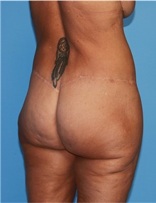 Body Lift Before Photo by Siamak Agha, MD PhD FACS; Newport Beach, CA - Case 43949
