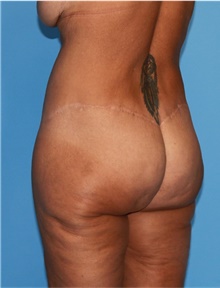Body Lift Before Photo by Siamak Agha, MD PhD FACS; Newport Beach, CA - Case 43949