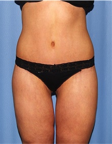 Body Lift After Photo by Siamak Agha, MD PhD FACS; Newport Beach, CA - Case 43950