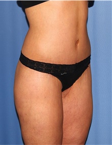 Body Lift After Photo by Siamak Agha, MD PhD FACS; Newport Beach, CA - Case 43950